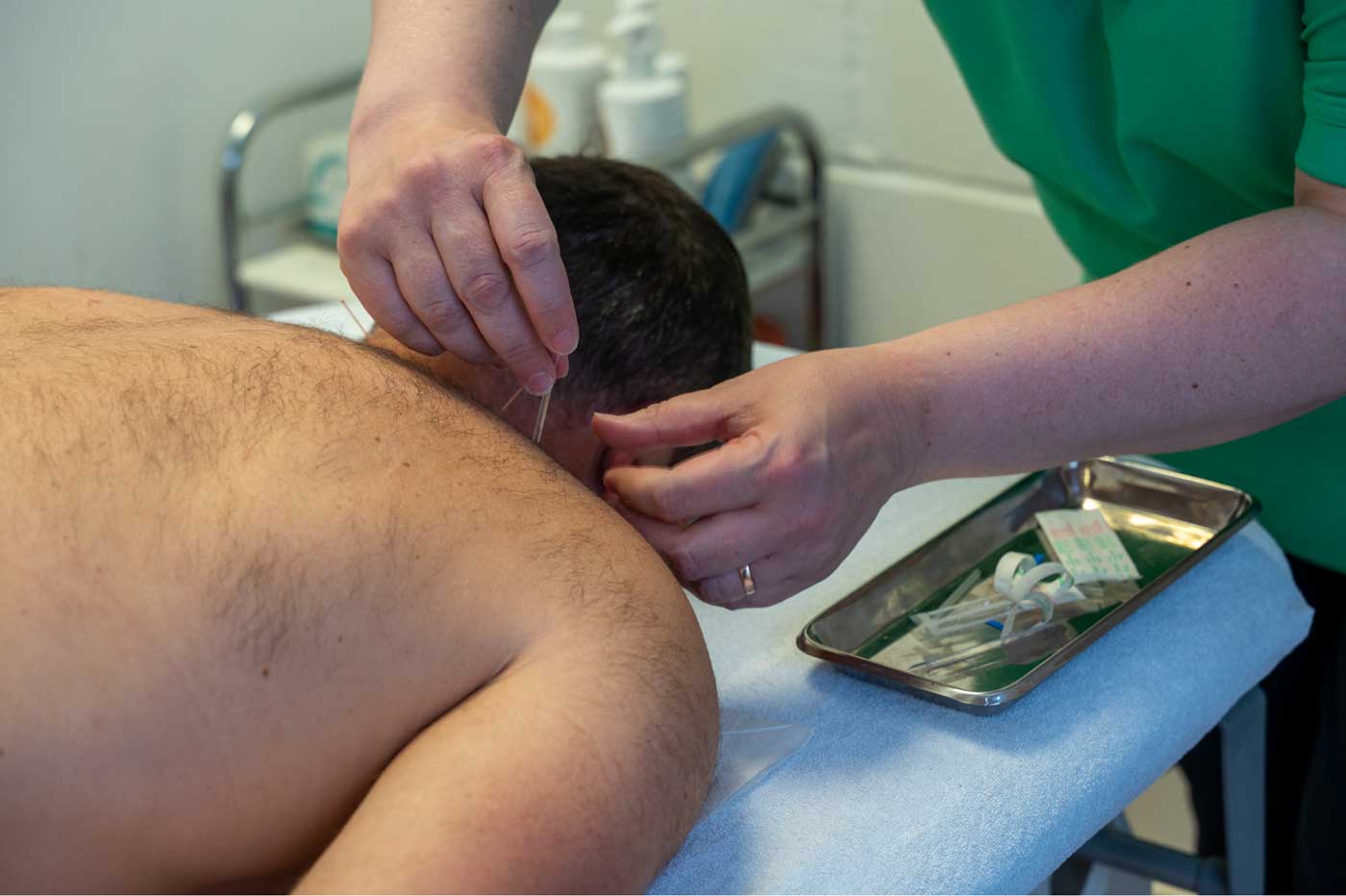 acupuncture